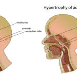 Adenoidid