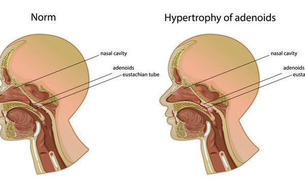 Adenoidid